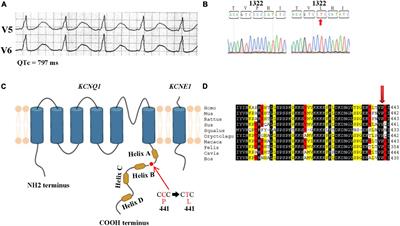 Association of the P441L KCNQ1 variant with severity of long QT syndrome and risk of cardiac events